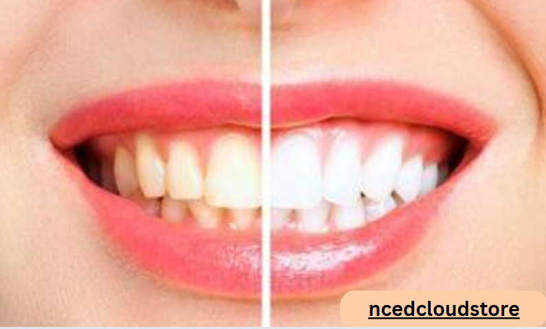 How to Maintain Your Bright Smile After Teeth Whitening Treatment