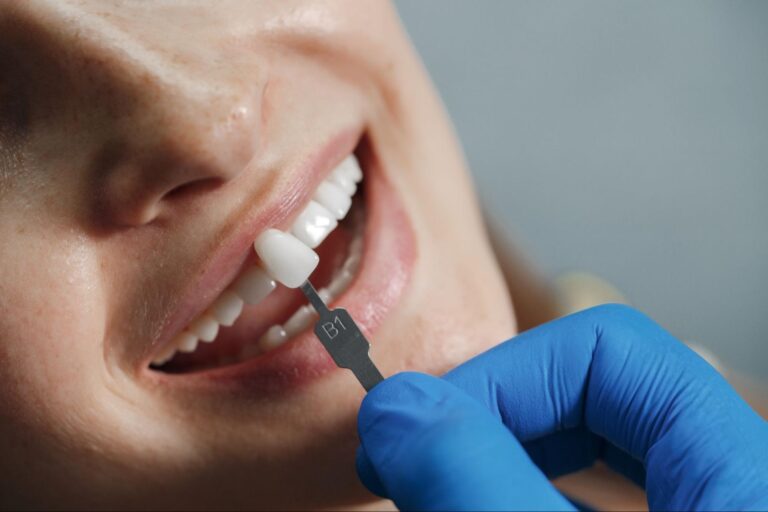 How Dental Bridges Improve Your Oral Health